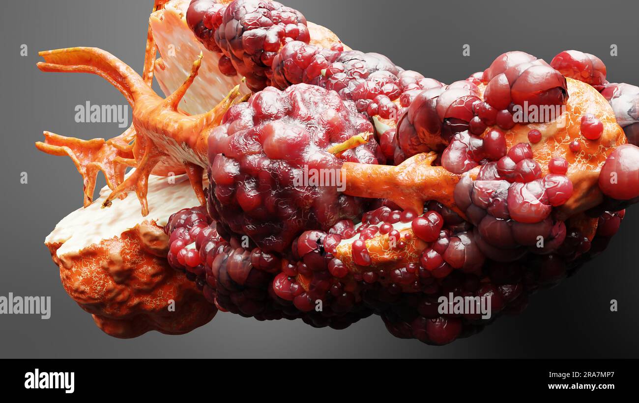 Malattia pancreatica, ghiandola digestiva, diagramma anatomico del cancro del pancreas umano, medico accurato, crescita e diffusione del tumore maligno, cellule mutanti, Foto Stock