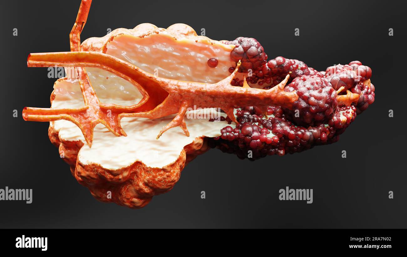 Malattia pancreatica, ghiandola digestiva, diagramma anatomico del cancro del pancreas umano, medico accurato, crescita e diffusione del tumore maligno, cellule mutanti, Foto Stock