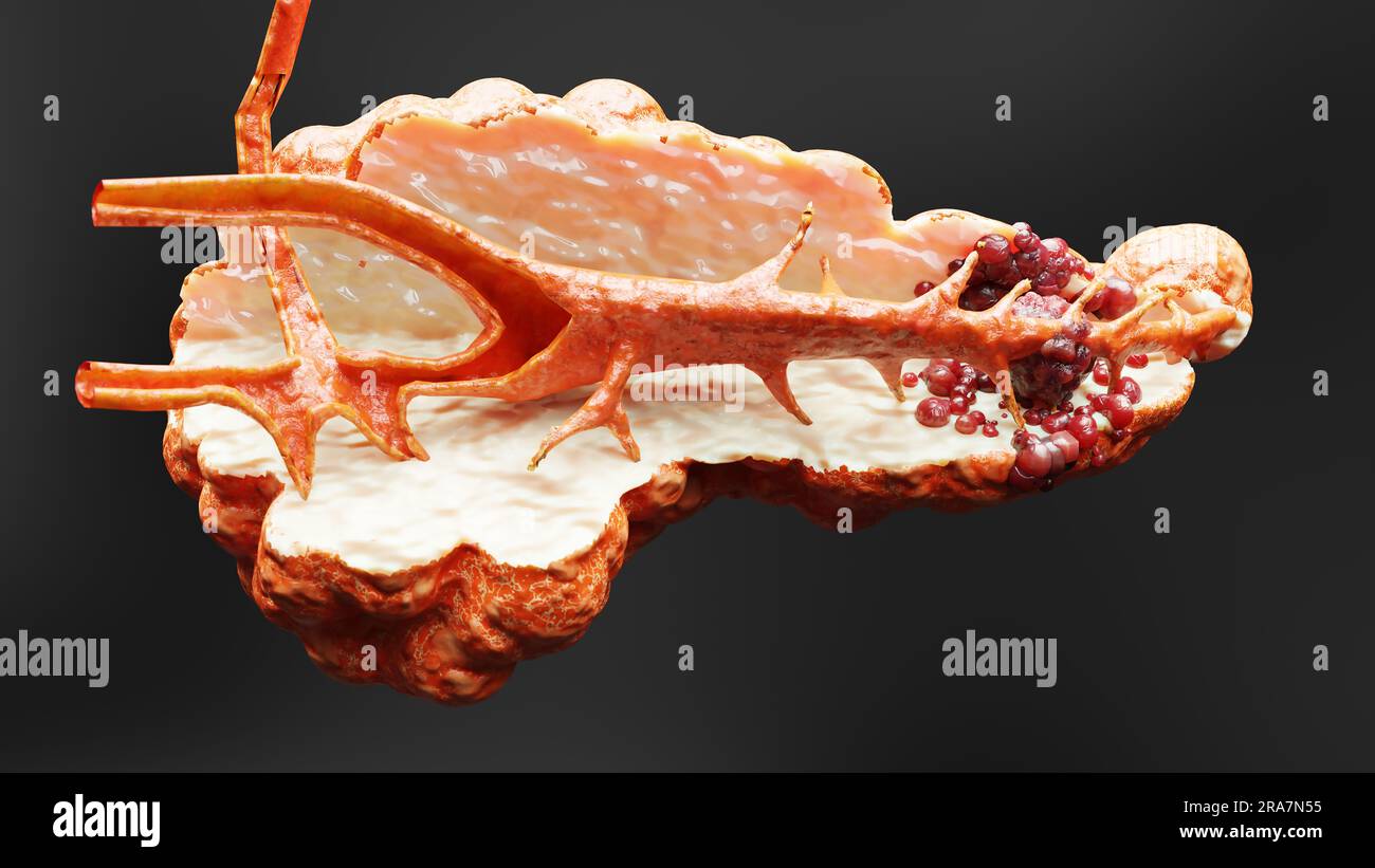 Malattia pancreatica, ghiandola digestiva, diagramma anatomico del cancro del pancreas umano, medico accurato, crescita e diffusione del tumore maligno, cellule mutanti, Foto Stock