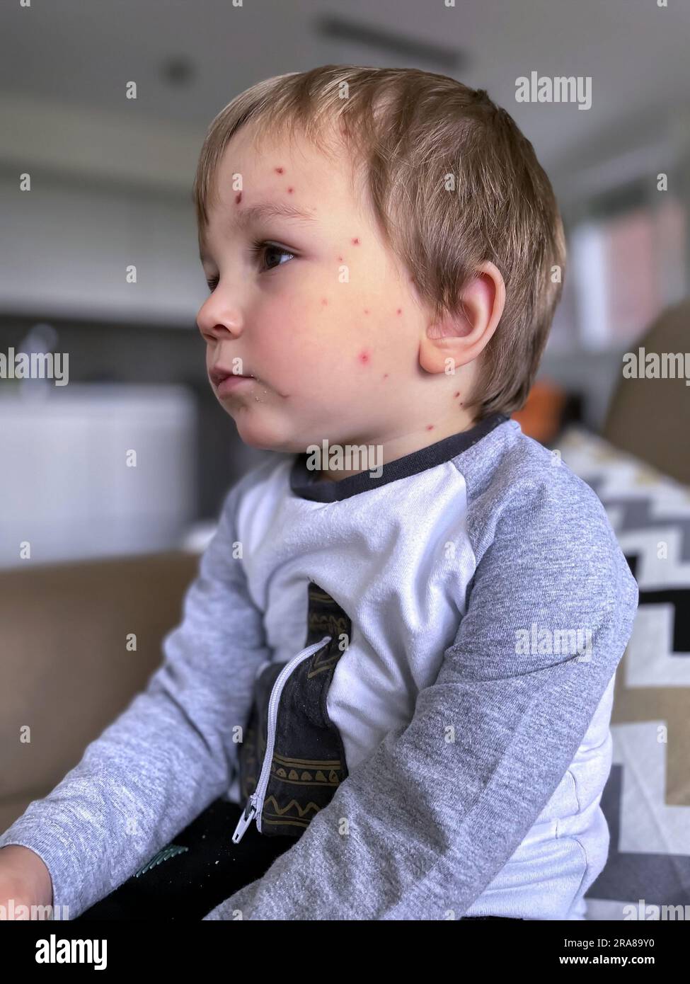 Eruzione della bolla di varicella sul viso del bambino. Bambino malato con varicella. Foto Stock