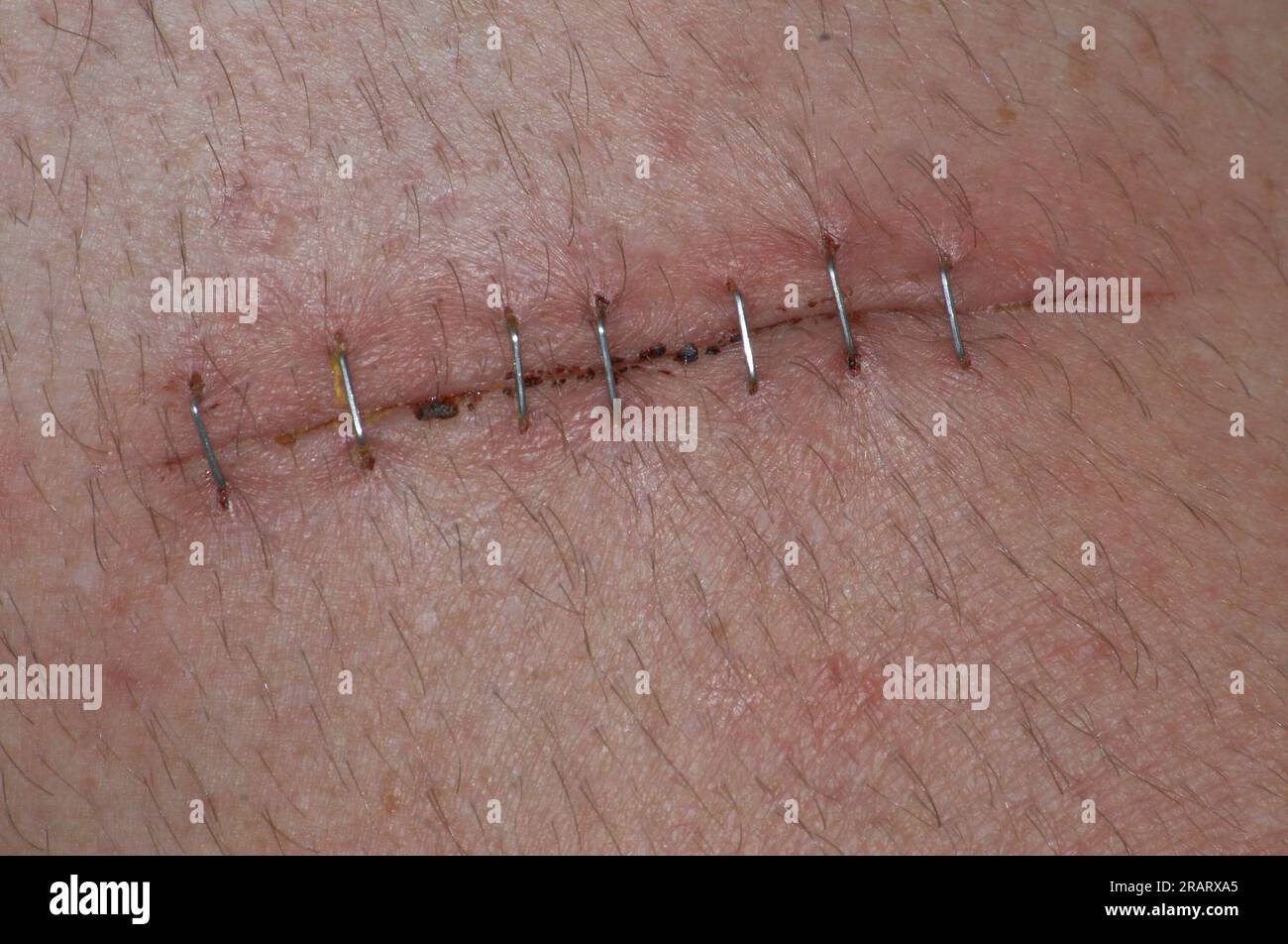taglio profondo sulla pelle con punti metallici Foto Stock