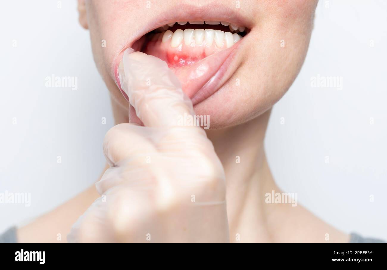 Ravvicinare la stomatite aftosa sulle gengive. Il medico controlla la piccola ulcera nella bocca della donna. La mano del medico nel guanto tira il labbro caucasico femminile, bianco Foto Stock