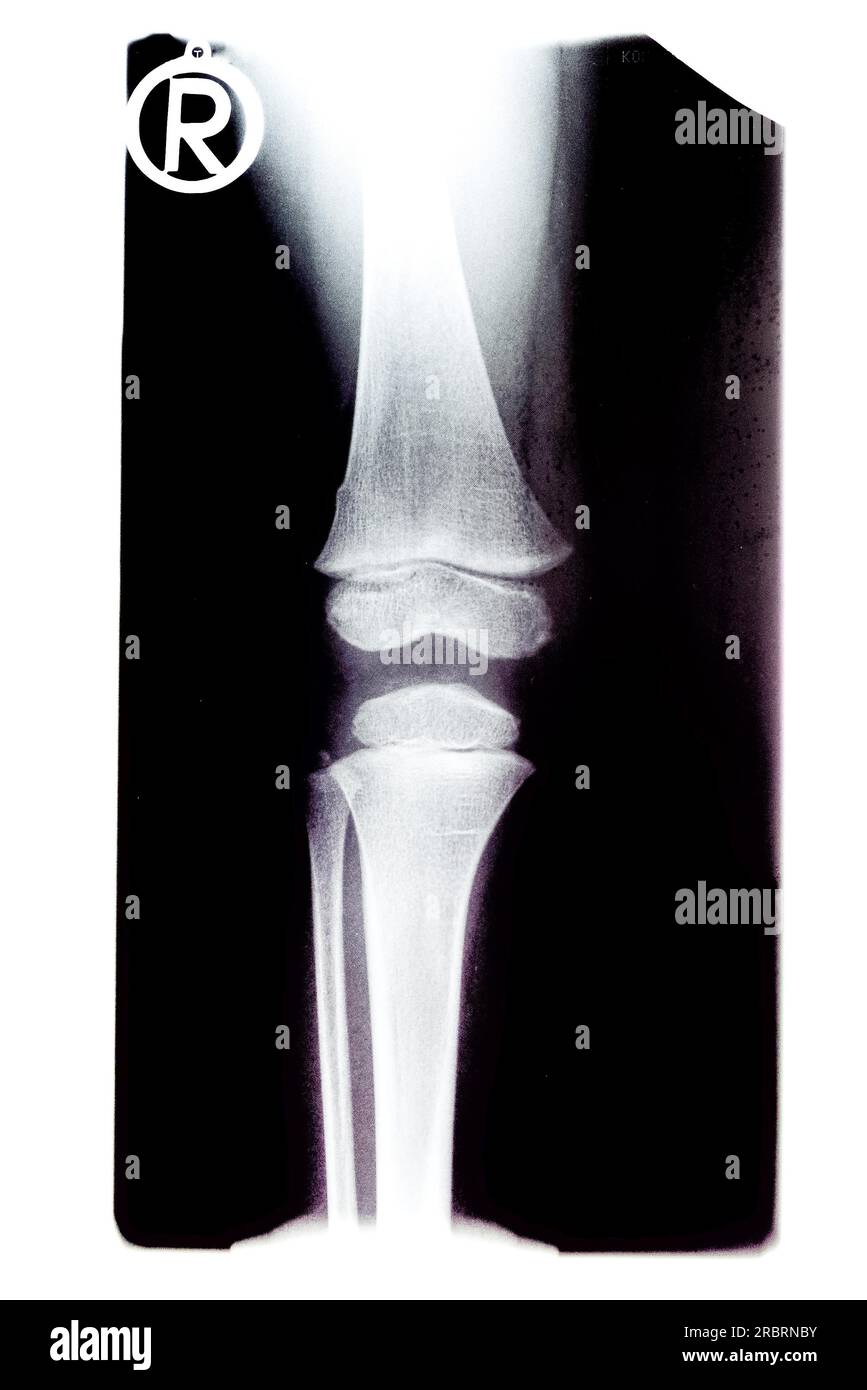 Pellicola radiografica di un femore e ginocchio dei bambini che mostra la formazione dell'articolazione, della cartilagine, del femore e dell'articolazione con la tibia, presa da A. Foto Stock