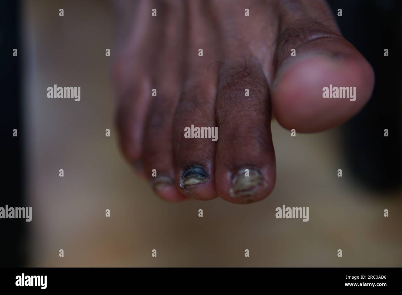 Fungo delle unghie delle dita del piede Foto Stock