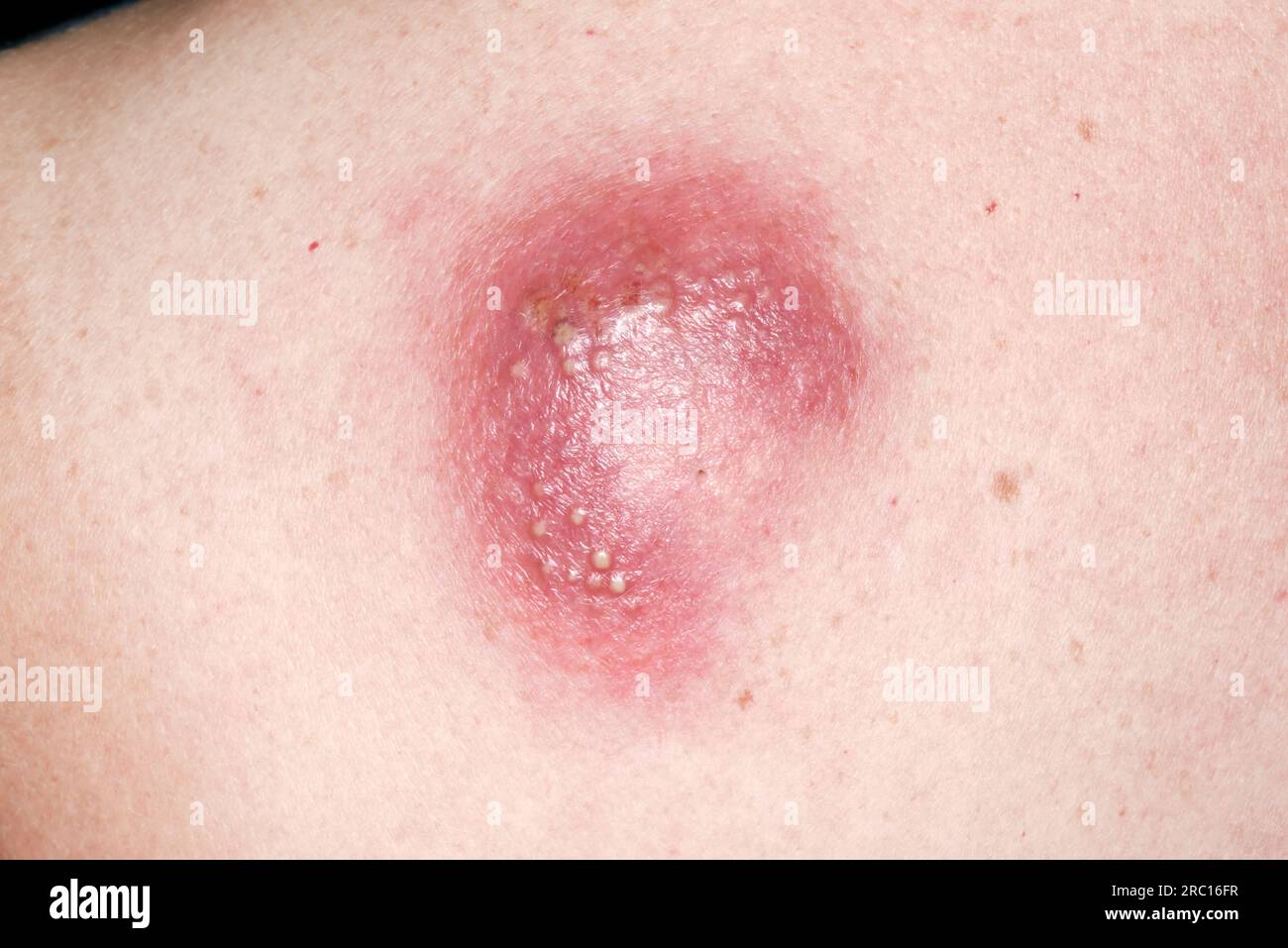 Cisti sebacea infetta Foto Stock