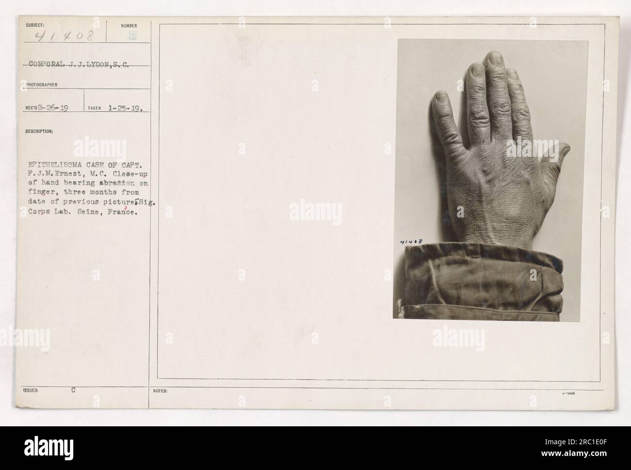 Foto ravvicinata del caporale J.J. La mano di Lydon mostra un'abrasione al dito. La foto è stata scattata il 1-35-19 su 81. Laboratorio del corpo a Senna, Francia. Questa immagine documenta un caso di epithe Foto Stock