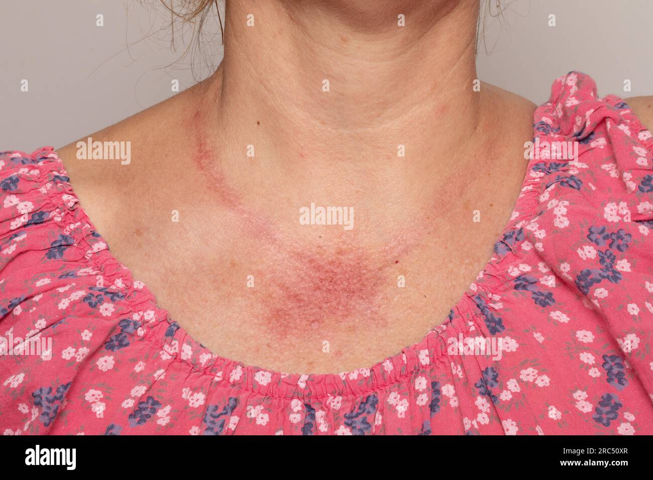 Eruzione cutanea rossa sul collo immagini e fotografie stock ad alta  risoluzione - Alamy