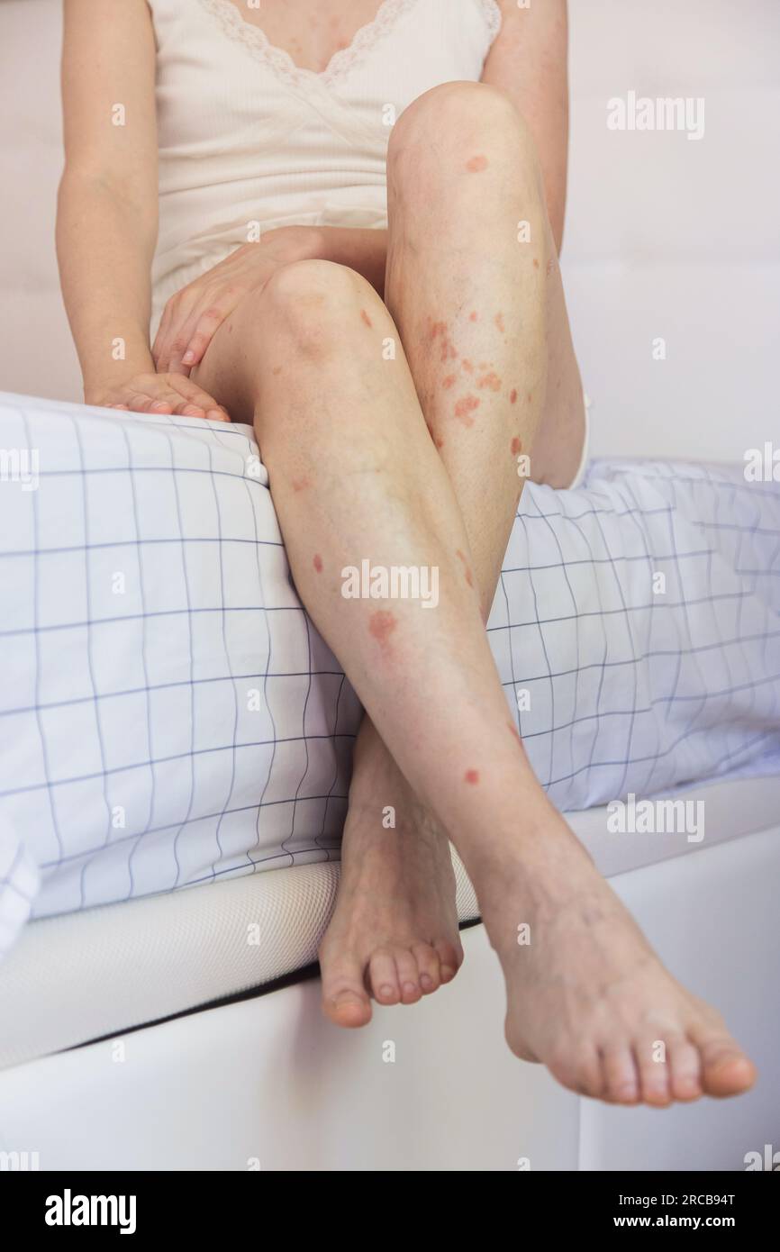 Primo piano di una persona che tiene una gamba.dettaglio del corpo di donna caucasica che mostra accettazione nonostante abbia problemi di pelle.concetto di inclusione e autostima Foto Stock