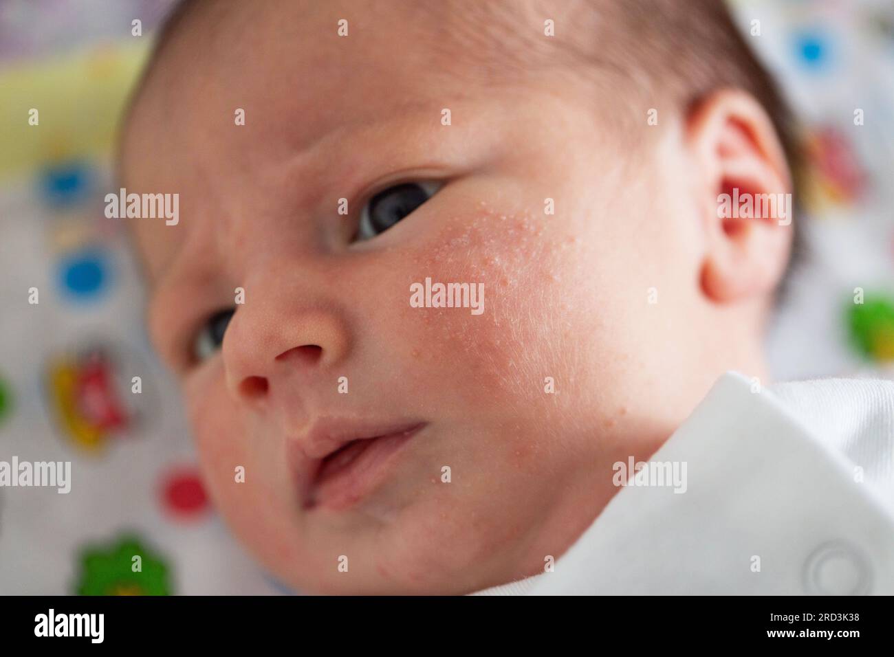 Brufoli sulla faccia di un neonato. L'adattamento del bambino all'ambiente  Foto stock - Alamy