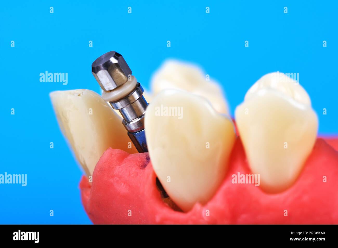 Dente dentale impianto che viene impiantato nell'osso mandibolare, close up Foto Stock