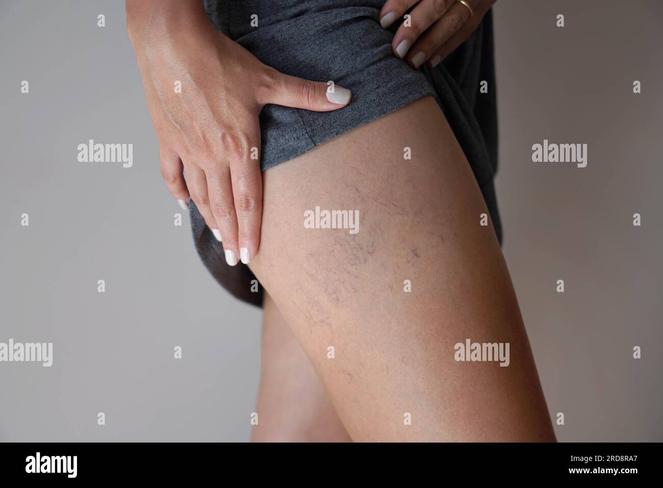 Vene varicose sulle gambe delle donne Foto Stock
