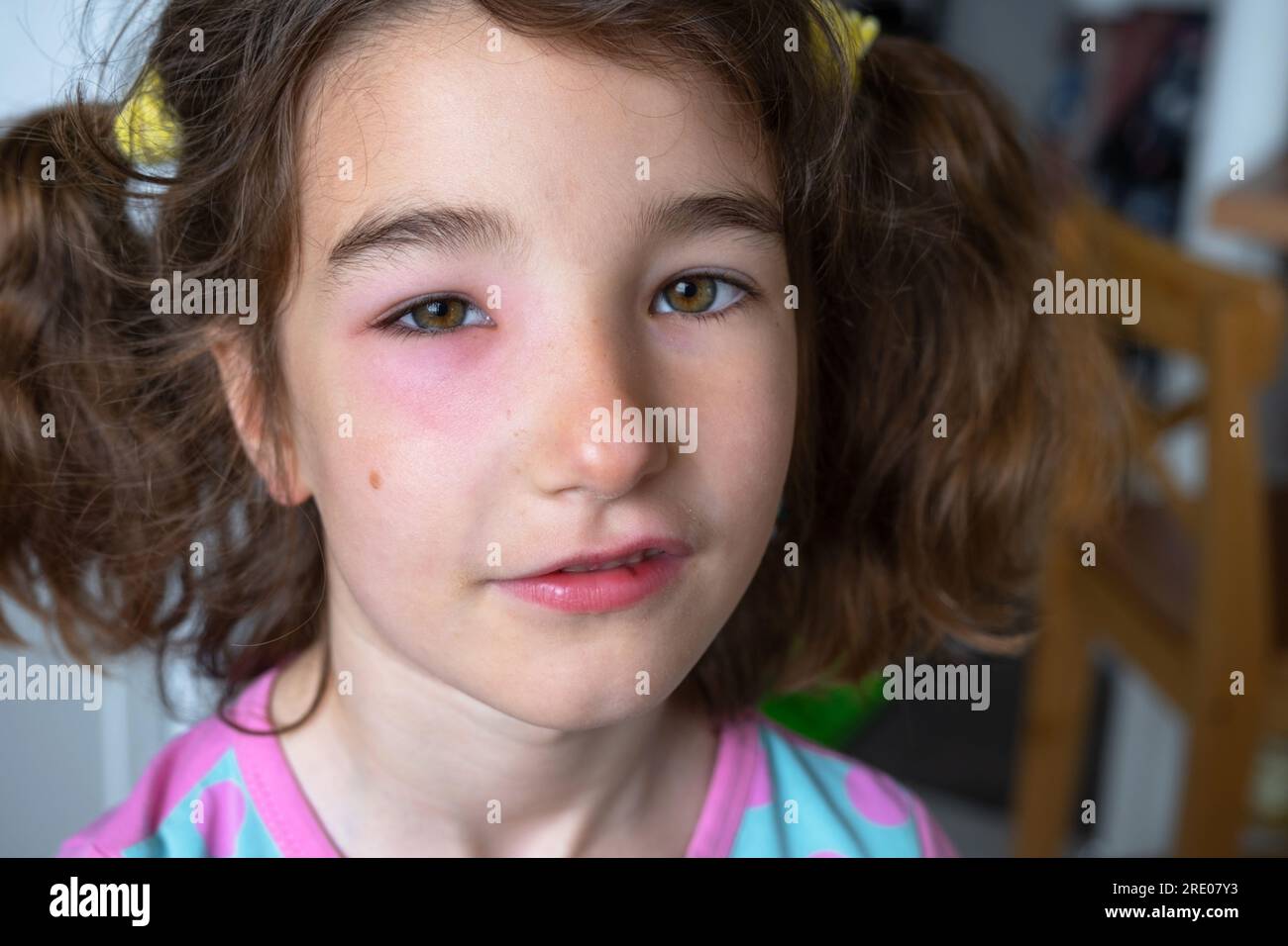 Una palpebra rossa gonfia sul viso di un bambino in primo piano è un'allergia al morso di un insetto. Reazione allergica agli insetti succhiatori di sangue Foto Stock