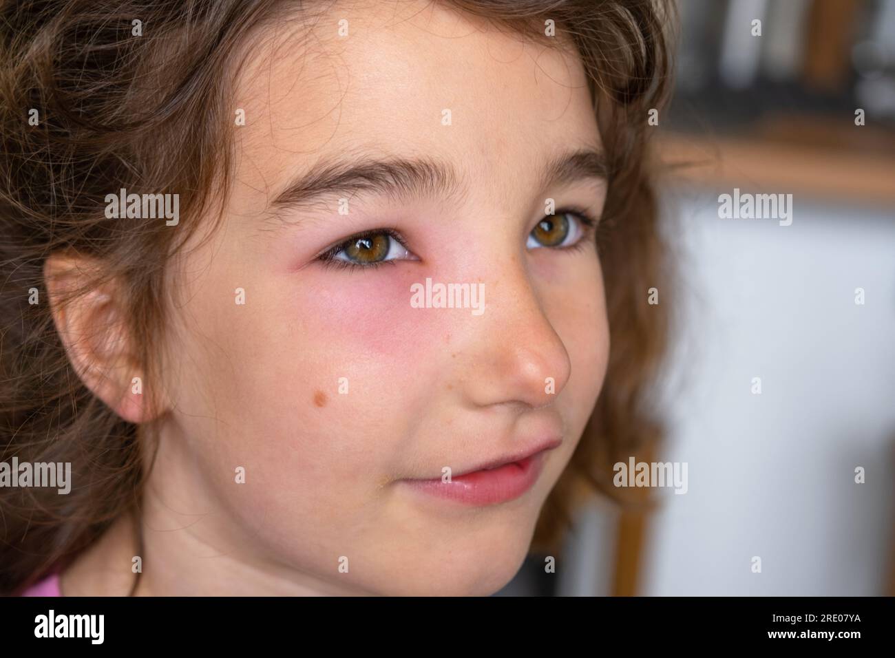 Una palpebra rossa gonfia sul viso di un bambino in primo piano è un'allergia al morso di un insetto. Reazione allergica agli insetti succhiatori di sangue Foto Stock