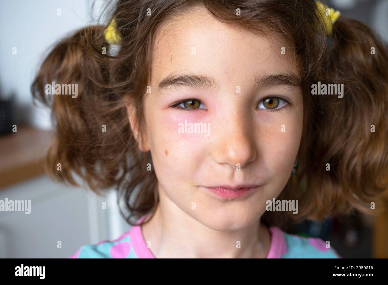 Una palpebra rossa gonfia sul viso di un bambino in primo piano è un'allergia al morso di un insetto. Reazione allergica agli insetti succhiatori di sangue Foto Stock