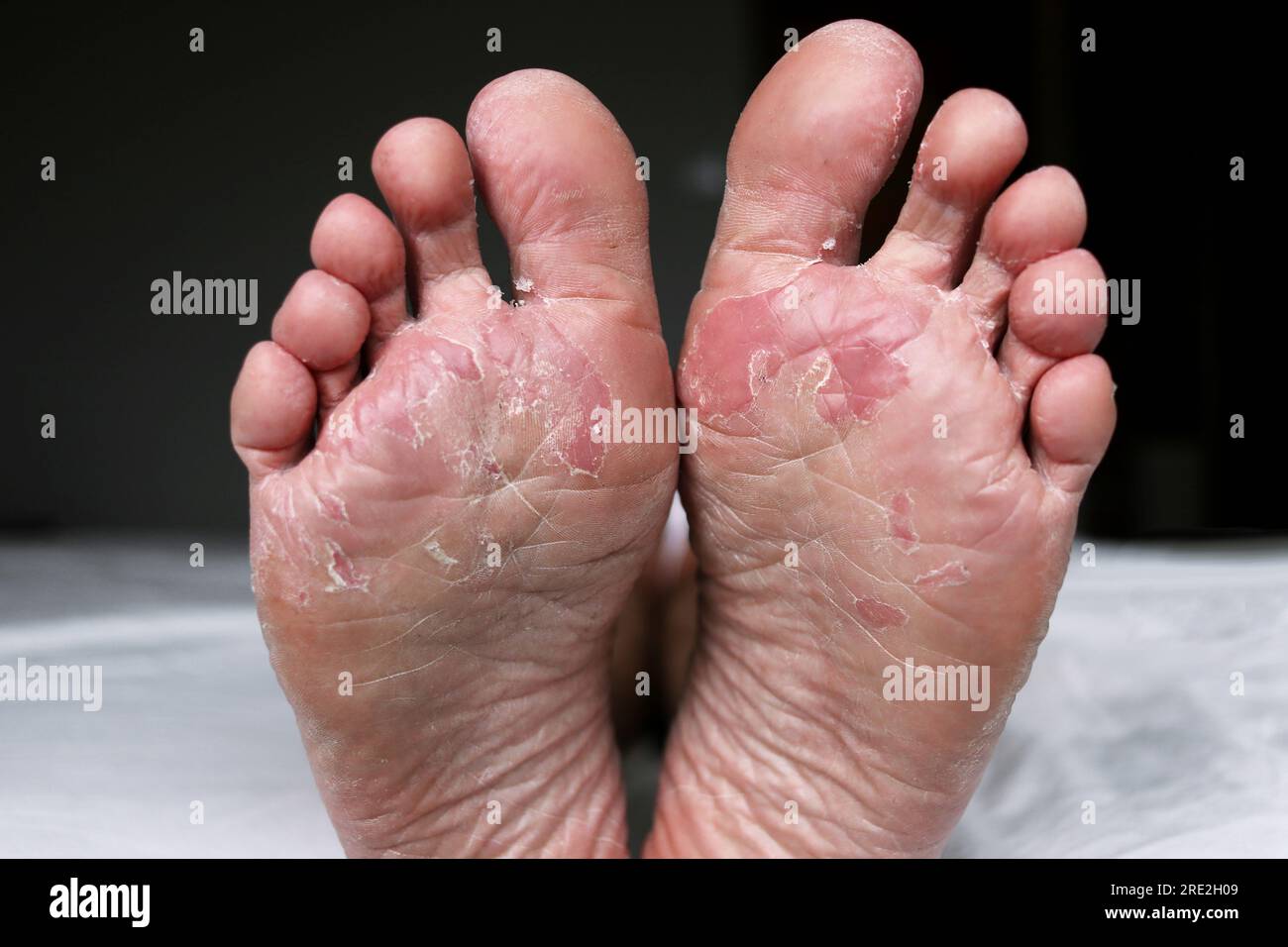 Primo piano dei piedi asciutti. Peeling e piede incrinato. Infezione micotica o piede dell'atleta, pelle secca, dermatite, eczema, psoriasi, piedi sudati o. Foto Stock