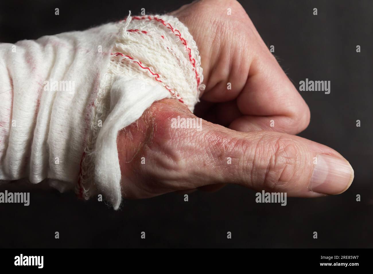 Primo piano di una mano bendata che mostra i resti di una ustione di secondo grado sulla nuca del pollice e le conseguenze di una lesione da ustione su un ba nero Foto Stock