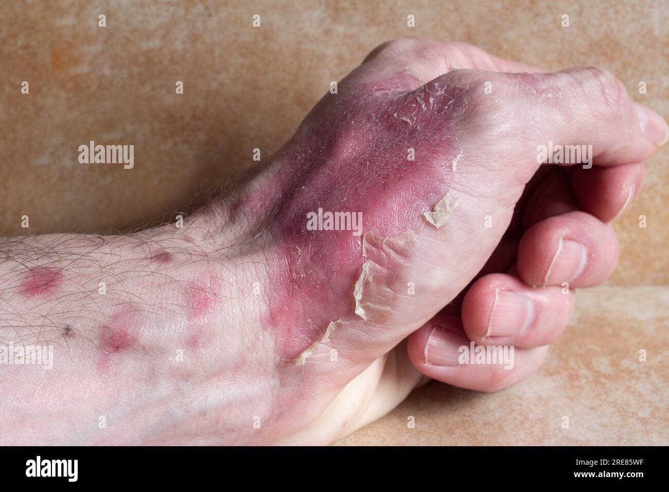 Primo piano di ustioni di secondo grado che rivelano un cambiamento di colore e consistenza della pelle sulla mano. Pronto soccorso, guarigione delle ferite, recupero delle ustioni. Foto Stock