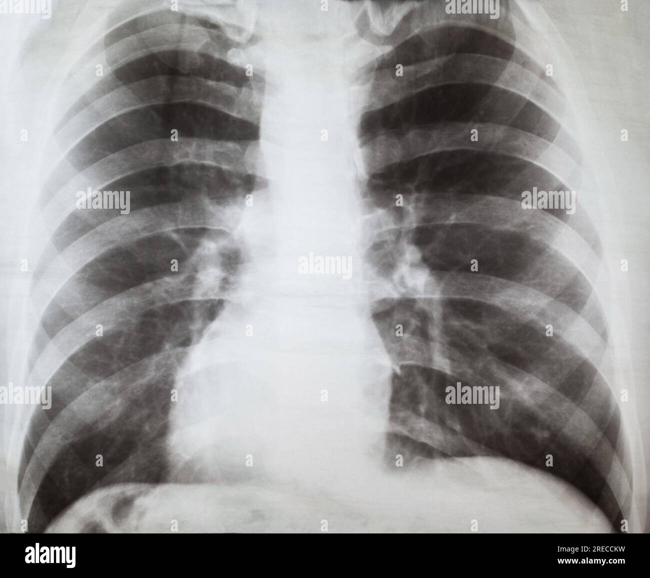 Raggi X dei polmoni umani, ricerca medica Foto Stock