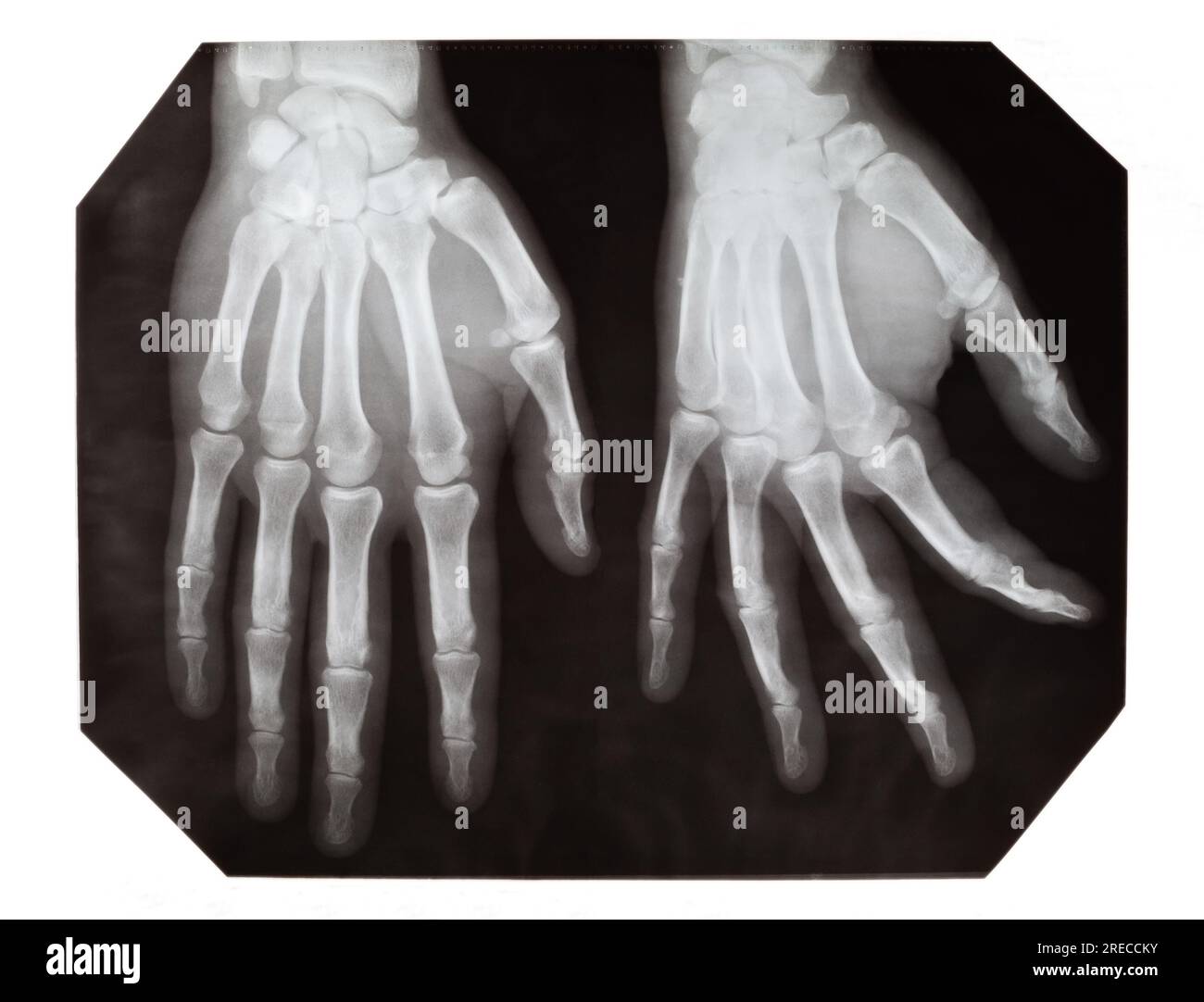 Immagini radiografiche di una mano con frattura in proiezioni diverse, su sfondo bianco Foto Stock