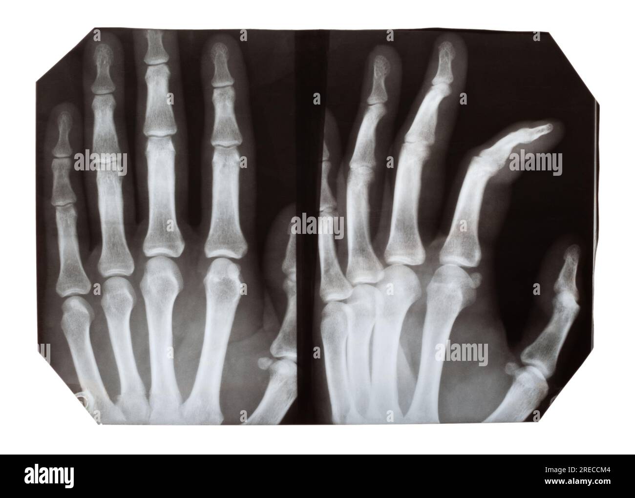 Immagini radiografiche di una mano in proiezioni diverse, su sfondo bianco Foto Stock