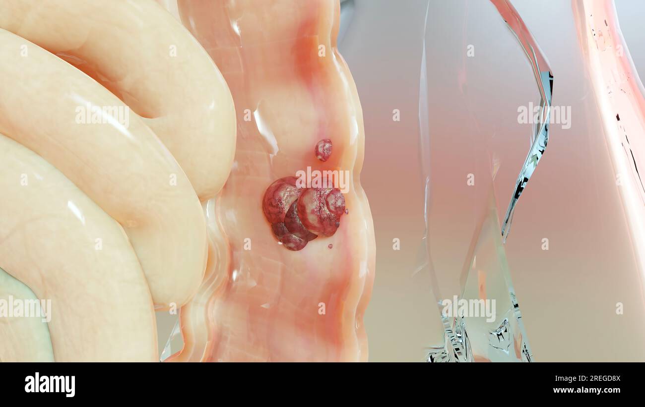 Cancro intestinale o tumore colorettale, cancro del colon, malattia infiammatoria intestinale, dolore intestinale, celiaco, infezioni, duplicazione, celle in espansione Foto Stock