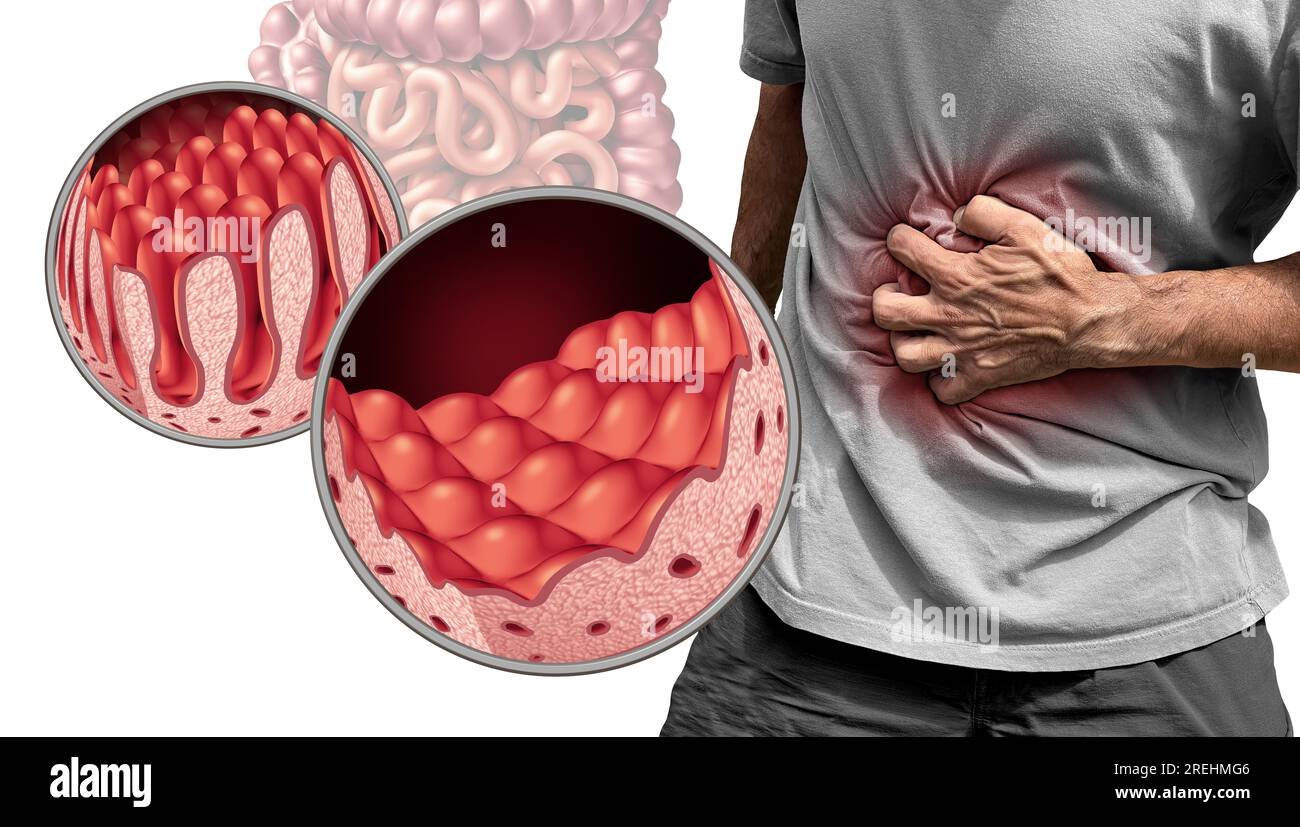 Celiachia o celiachia come concetto medico di anatomia intestinale con villi normali e rivestimento intestinale doloroso danneggiato come autoimmune Foto Stock