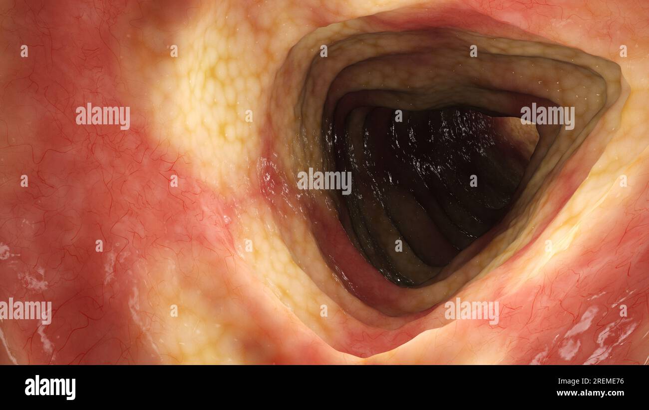 Morbo di Crohn nel colon, illustrazione. Foto Stock