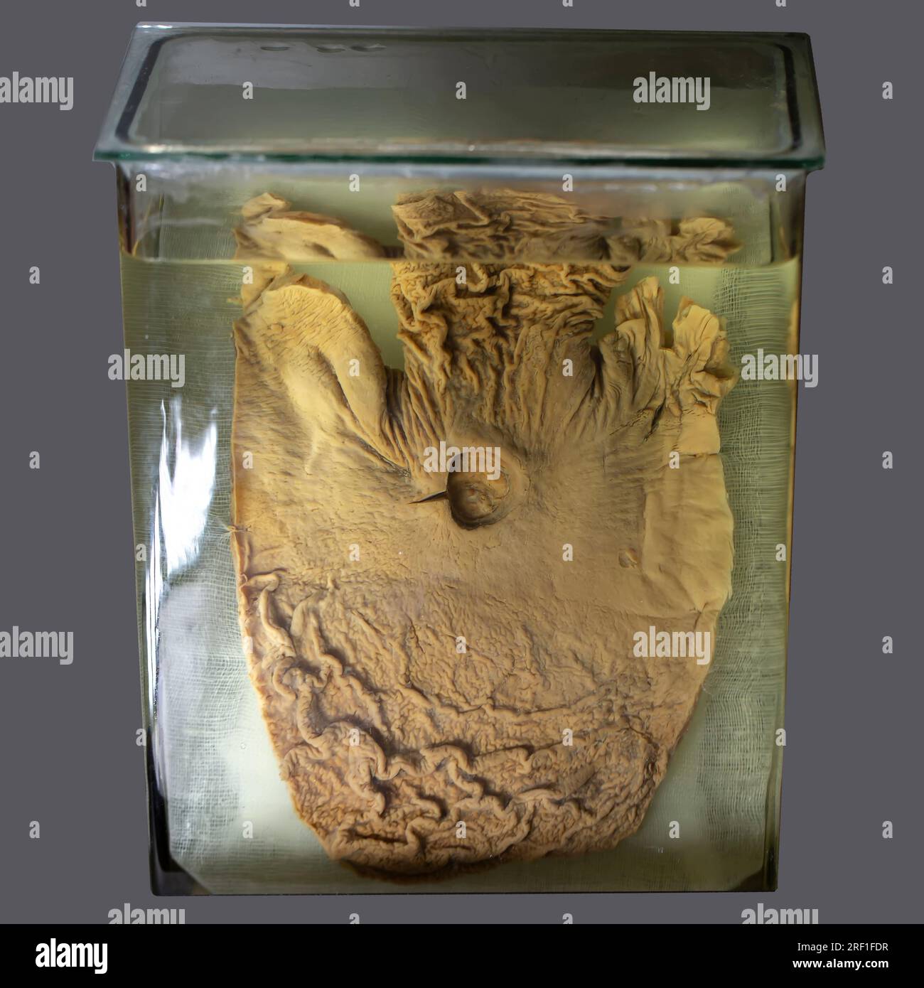 1° aprile 2023. Gomel. Mostra di oggetti anatomici. L'organo dello stomaco di una persona con un'ulcera perforata è una mostra anatomica conservata in un Foto Stock