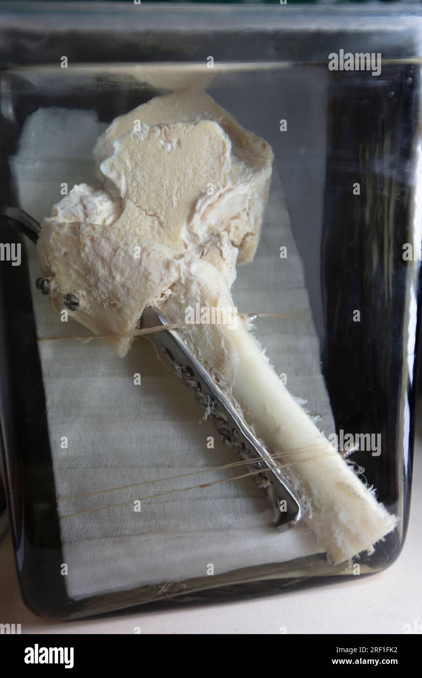 1° aprile 2023. Gomel. Mostra di oggetti anatomici. Un osso umano rotto è fissato con una piastra metallica e delle viti. Questa è una mostra anatomica pre Foto Stock
