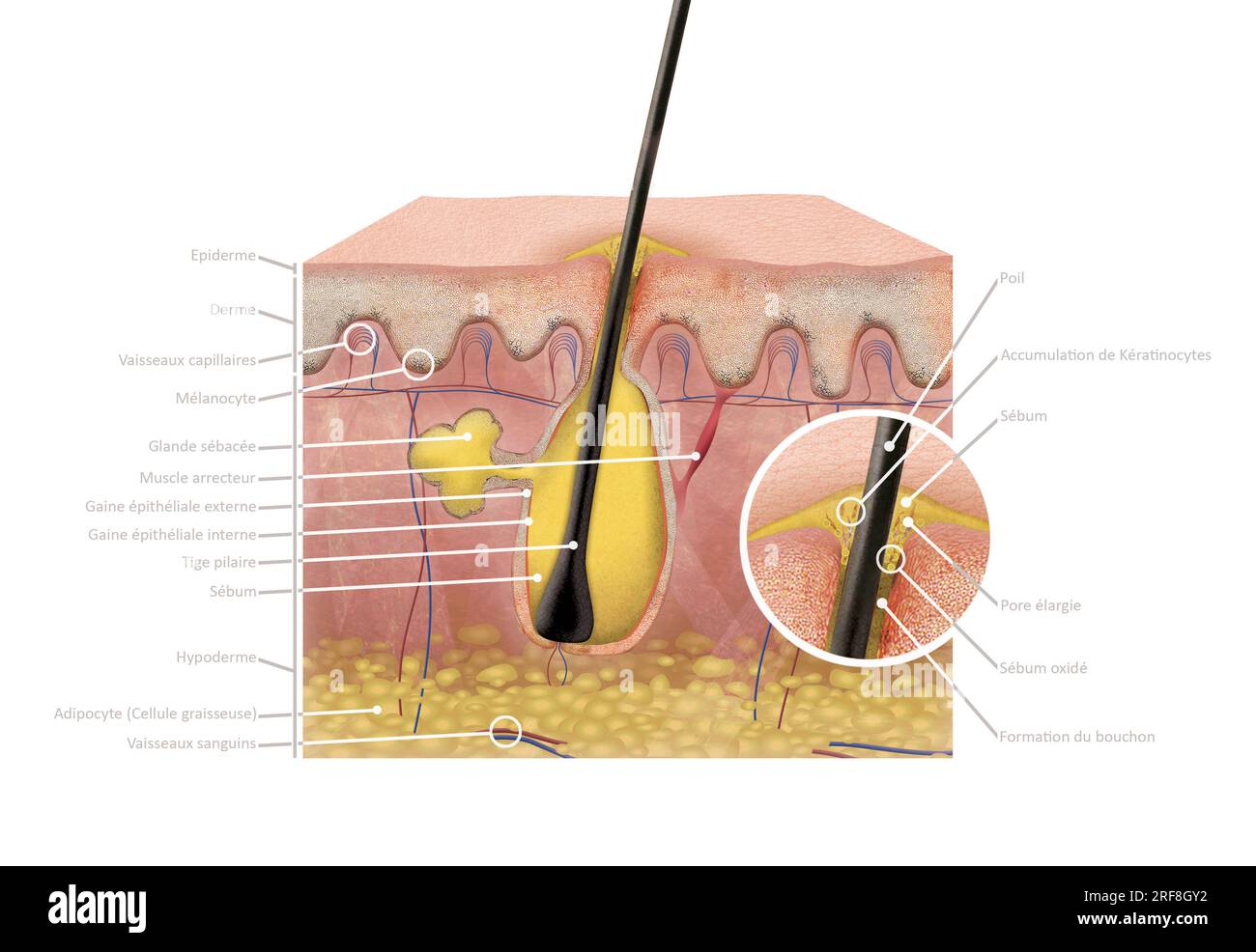 Sezione 2D della pelle con brufolo con epidermide, dermide e ipodermide, ghiandola sebacea, muscolo arrecatore, guaina epiteliale esterna ed interna, fusto dei capelli. Foto Stock
