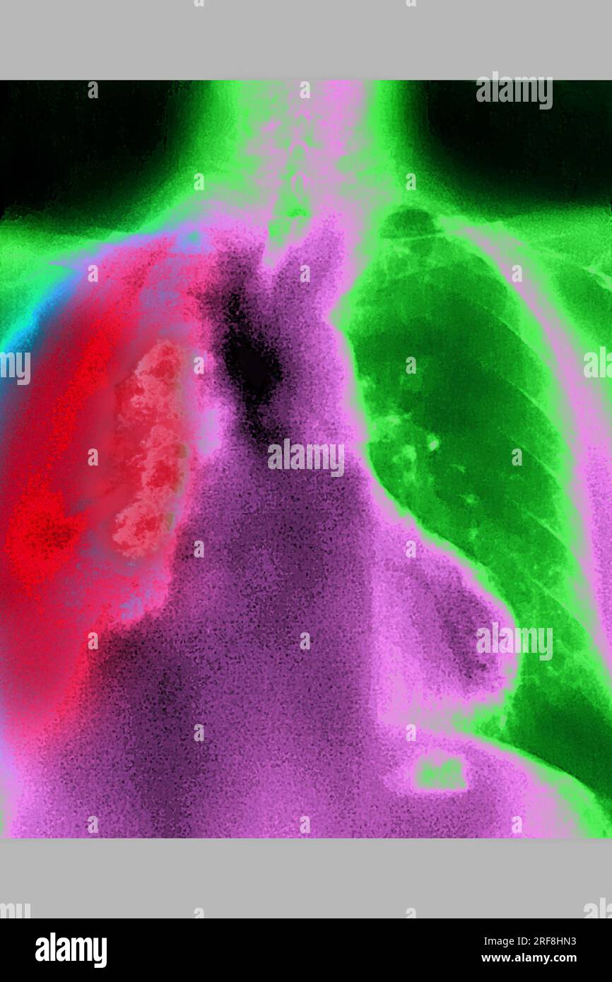 Cancro del polmone (destro), visualizzato da una radiografia toracica AP. Foto Stock