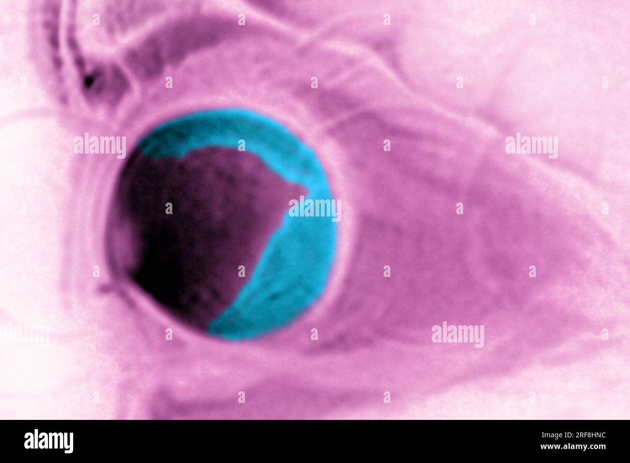 Distacco retinico dell'occhio sinistro, visualizzato mediante RM a sezione radiale. Foto Stock