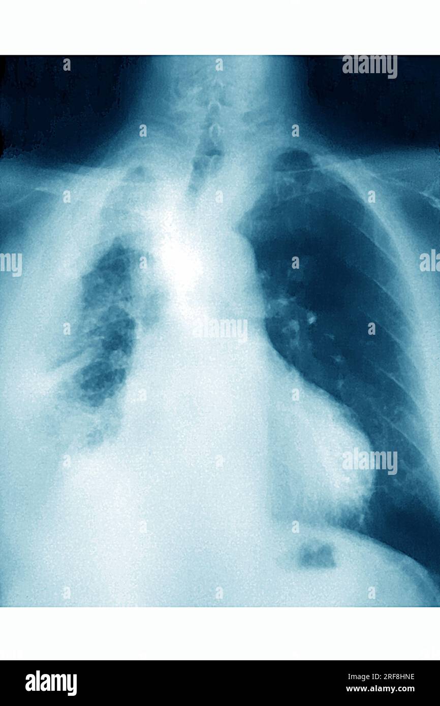 Cancro del polmone (destro), visualizzato da una radiografia toracica AP. Foto Stock