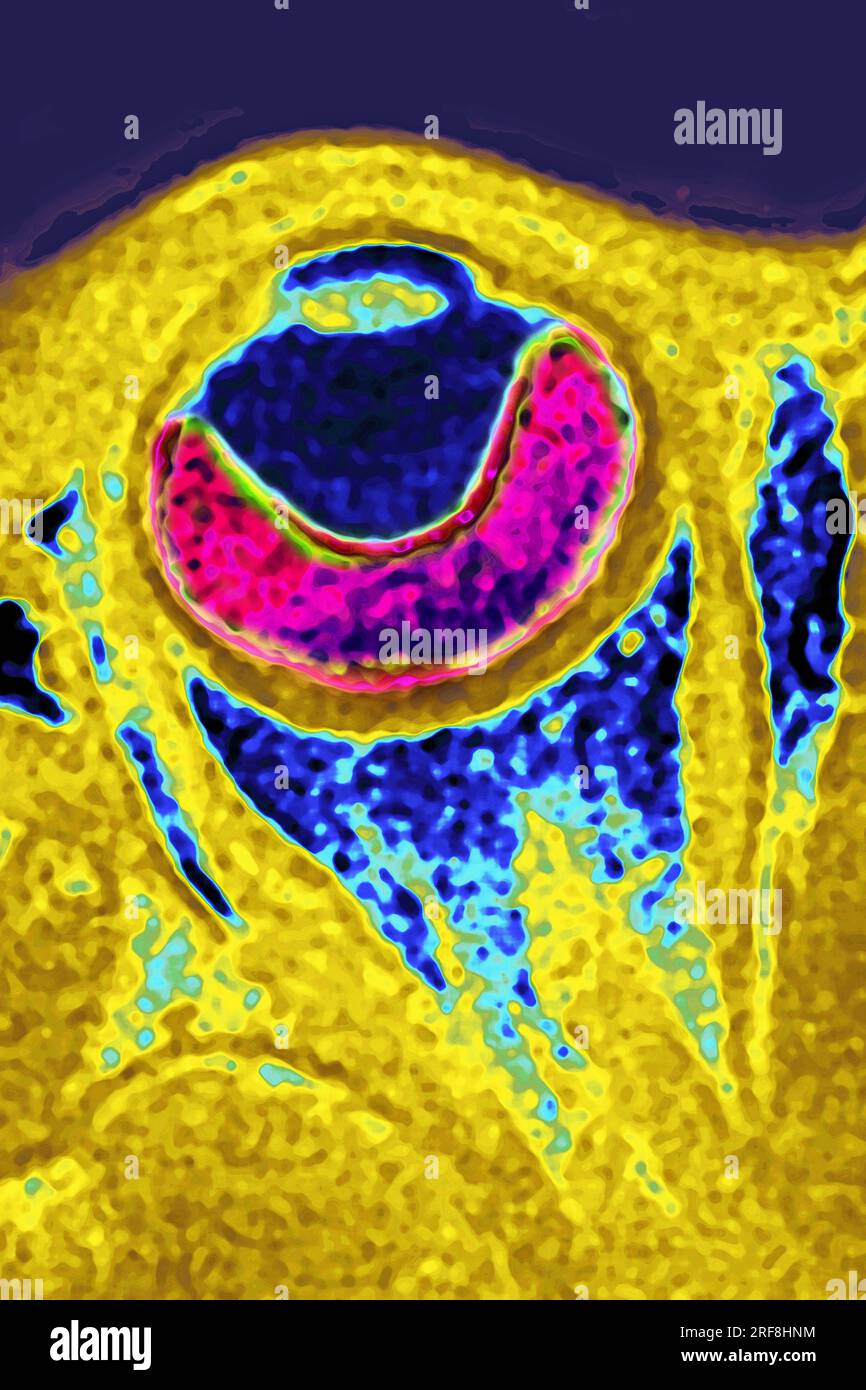 Distacco retinico dell'occhio sinistro, visualizzato mediante RM a sezione radiale. Foto Stock