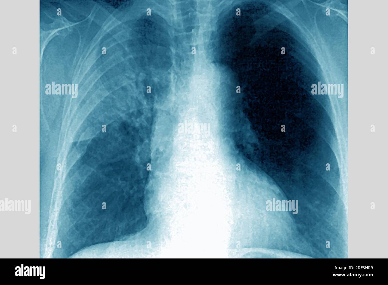 Polmonite in un polmone destro (infezione respiratoria acuta), rivelata dalla radiografia frontale del torace. Foto Stock
