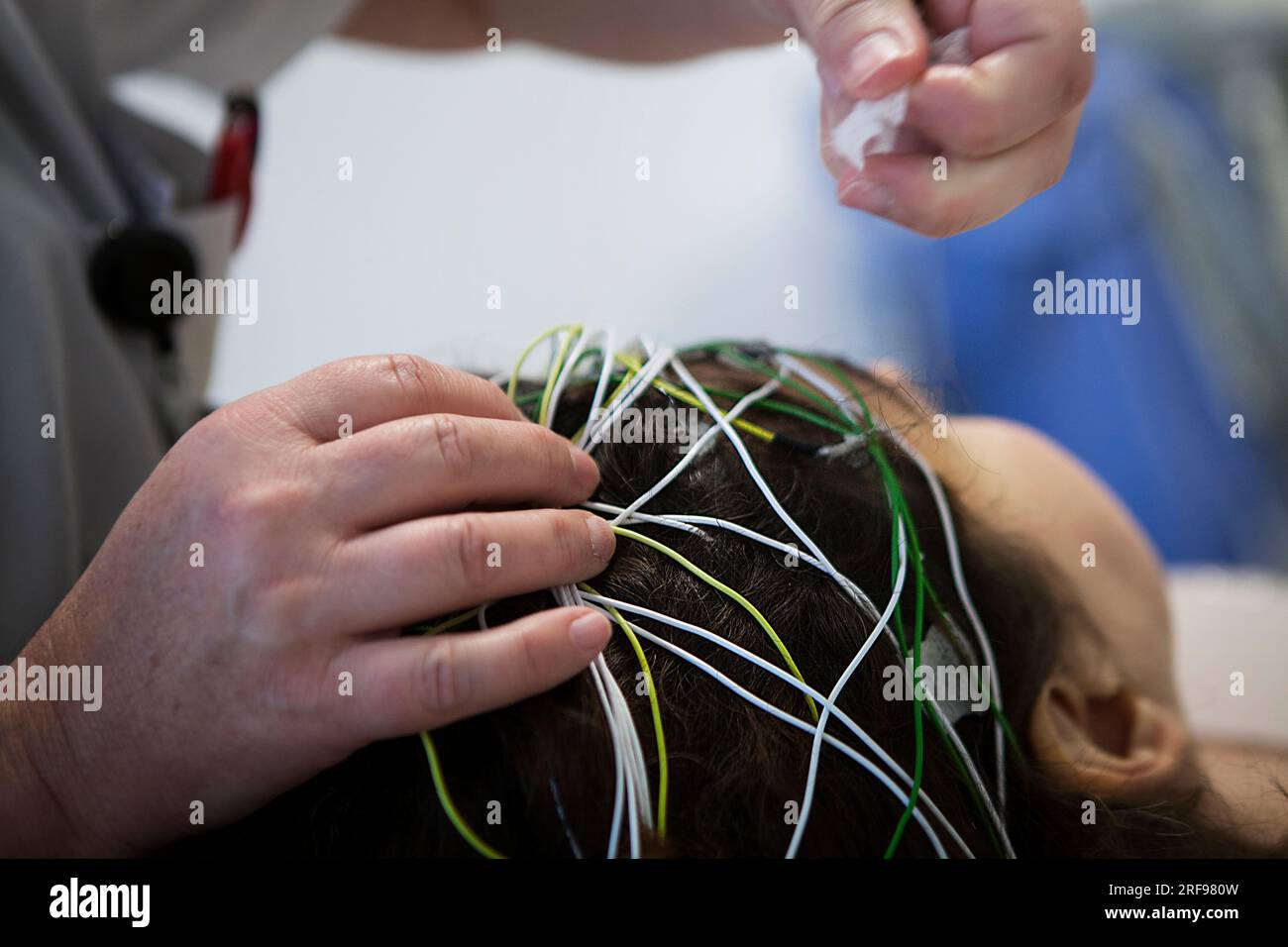 Neurologia: Screening e monitoraggio dell'epilessia, posizionamento degli elettrodi per EEG o elettroencefalogramma. Foto Stock