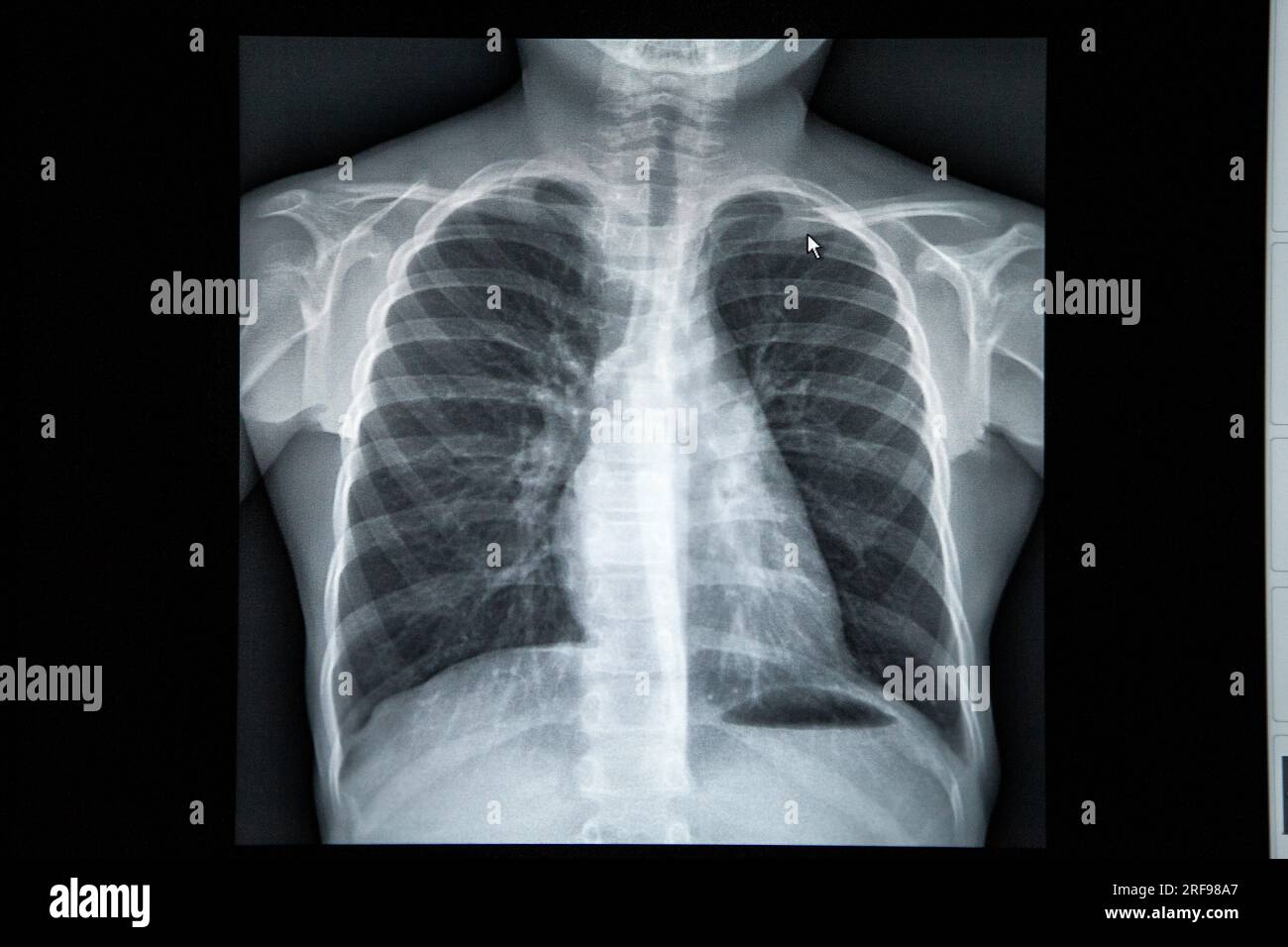 Radiografia toracica normale in un bambino, in un centro di radiologia. Foto Stock