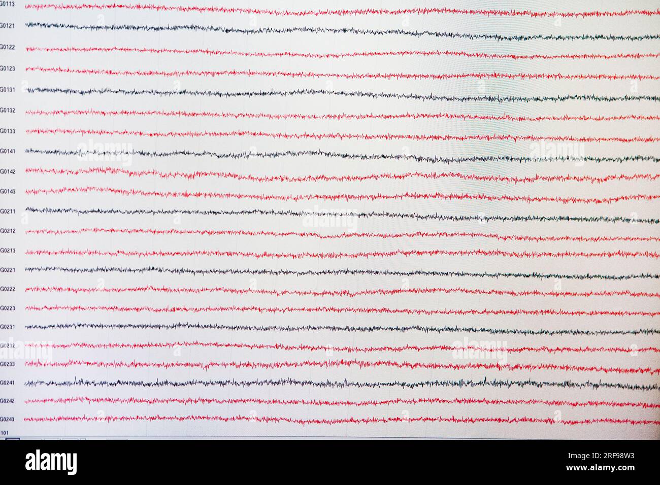 La magnetoencefalografia (MEG) è un neuroimaging che registra l'attività elettromagnetica del cervello con 306 sensori. Foto Stock