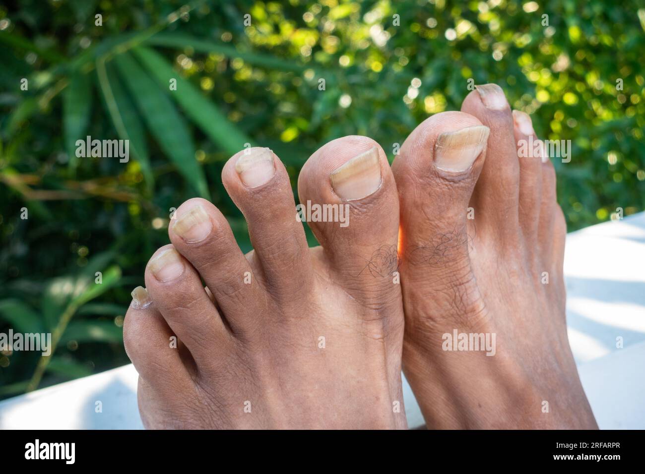 14 ottobre 2022 Uttarakhand, India. Unghie dei piedi trascurate di un adulto indiano con condizioni dei piedi non igieniche. Concetto di auto-cura e igiene personale. Foto Stock