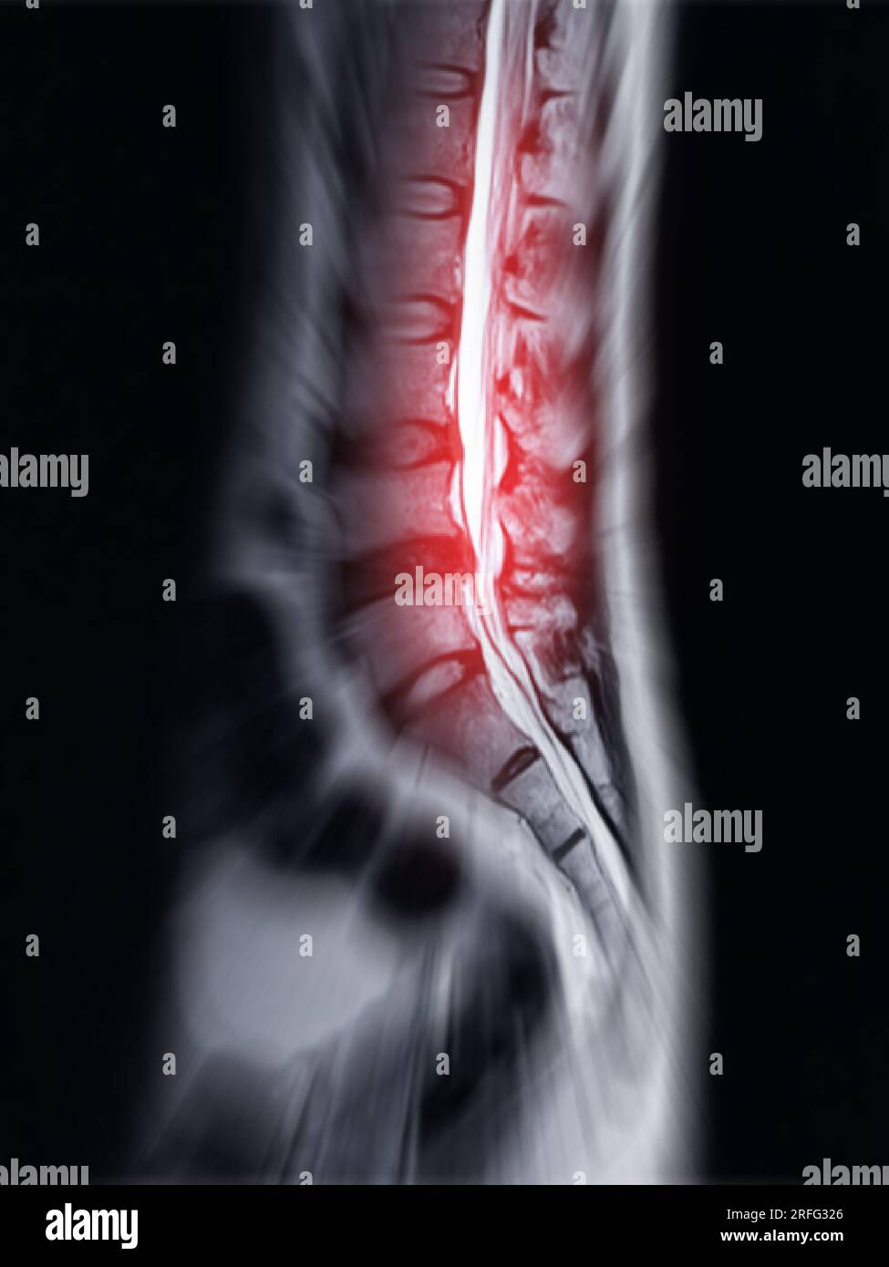 Vista RM colonna vertebrale L-S o colonna lombare Sagittall T2W per diagnosi compressione del midollo spinale. Foto Stock