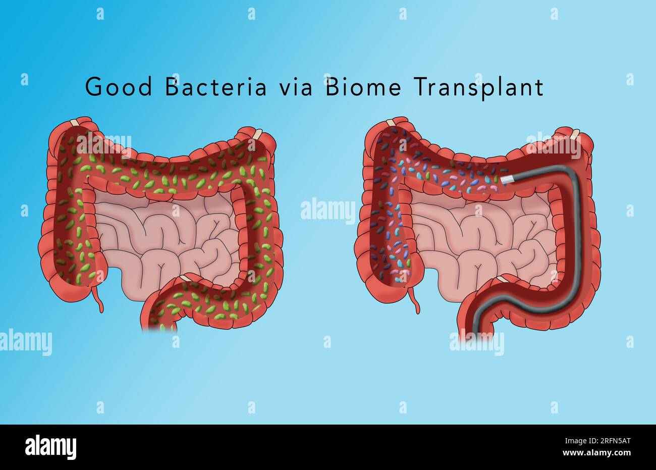 Un'illustrazione concettuale dell'intestino crasso. Quello sinistro è pieno di batteri cattivi e l'intestino destro è pieno con batteri buoni o benefici. Foto Stock
