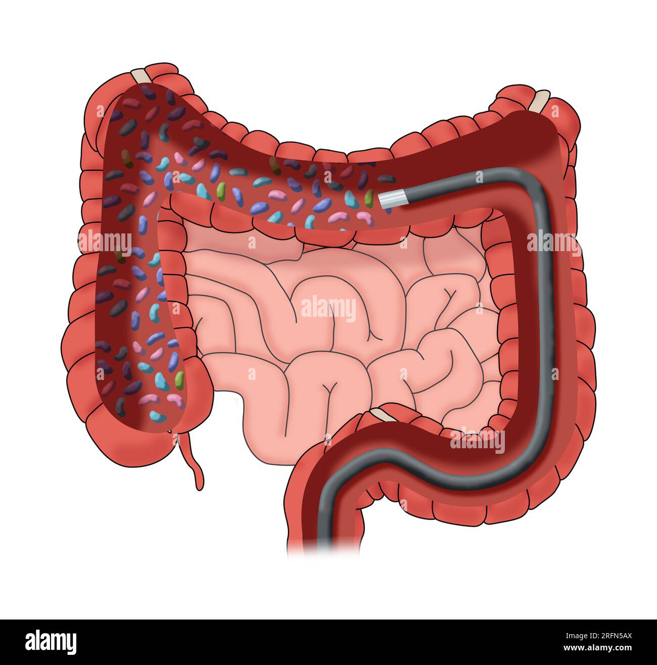 I batteri buoni vengono somministrati nell'intestino crasso tramite colonscopia. Foto Stock