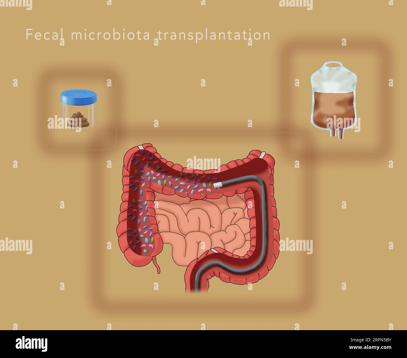 Un'illustrazione dei componenti del trapianto di microbiota fecale per migliorare il bioma umano. Le raccolte da un donatore sano, la preparazione con soluzione salina in una sacca di gocciolamento IV, e una colonscopia. Foto Stock