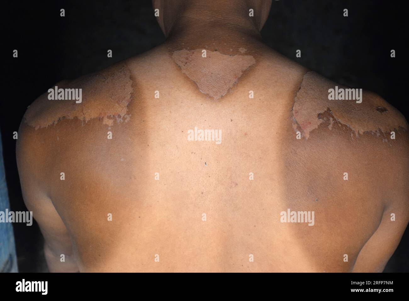 Peeling bruciata dal sole sul retro del corpo un uomo Foto Stock