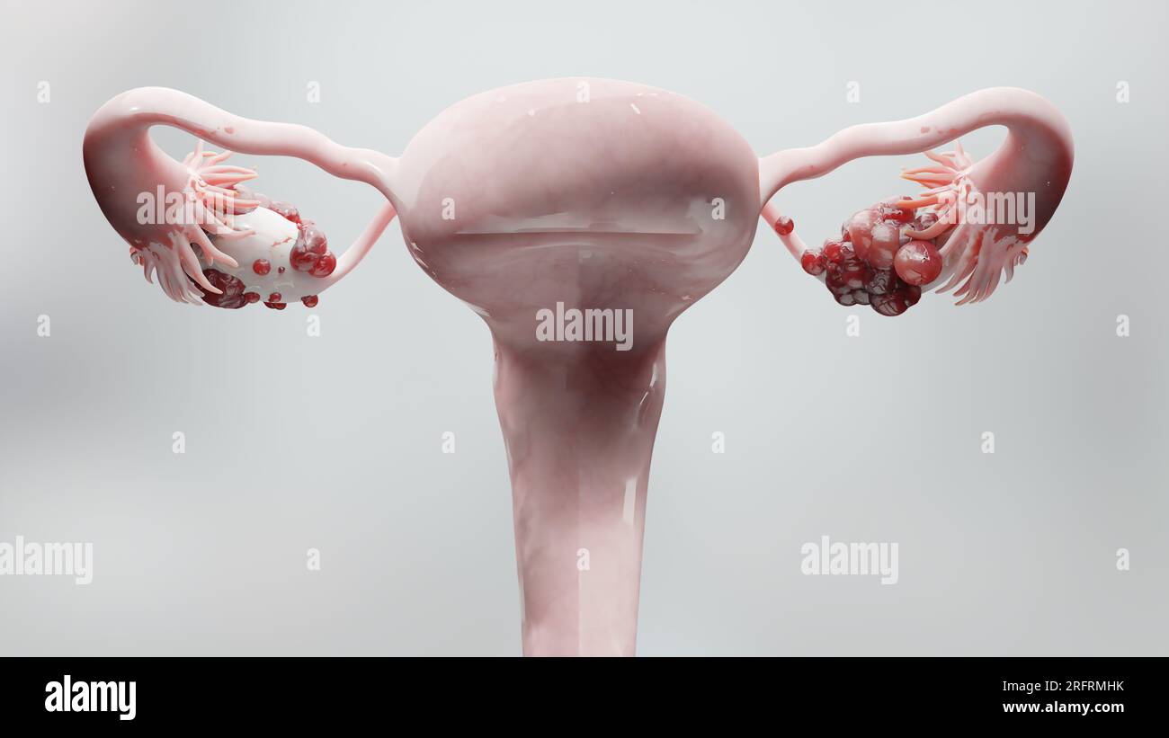 Tumore maligno dell'ovaio, anatomia dell'utero femminile, sistema riproduttivo, cellule tumorali, cisti ovariche, cancro cervicale, cellule in crescita, malattie ginecologiche Foto Stock