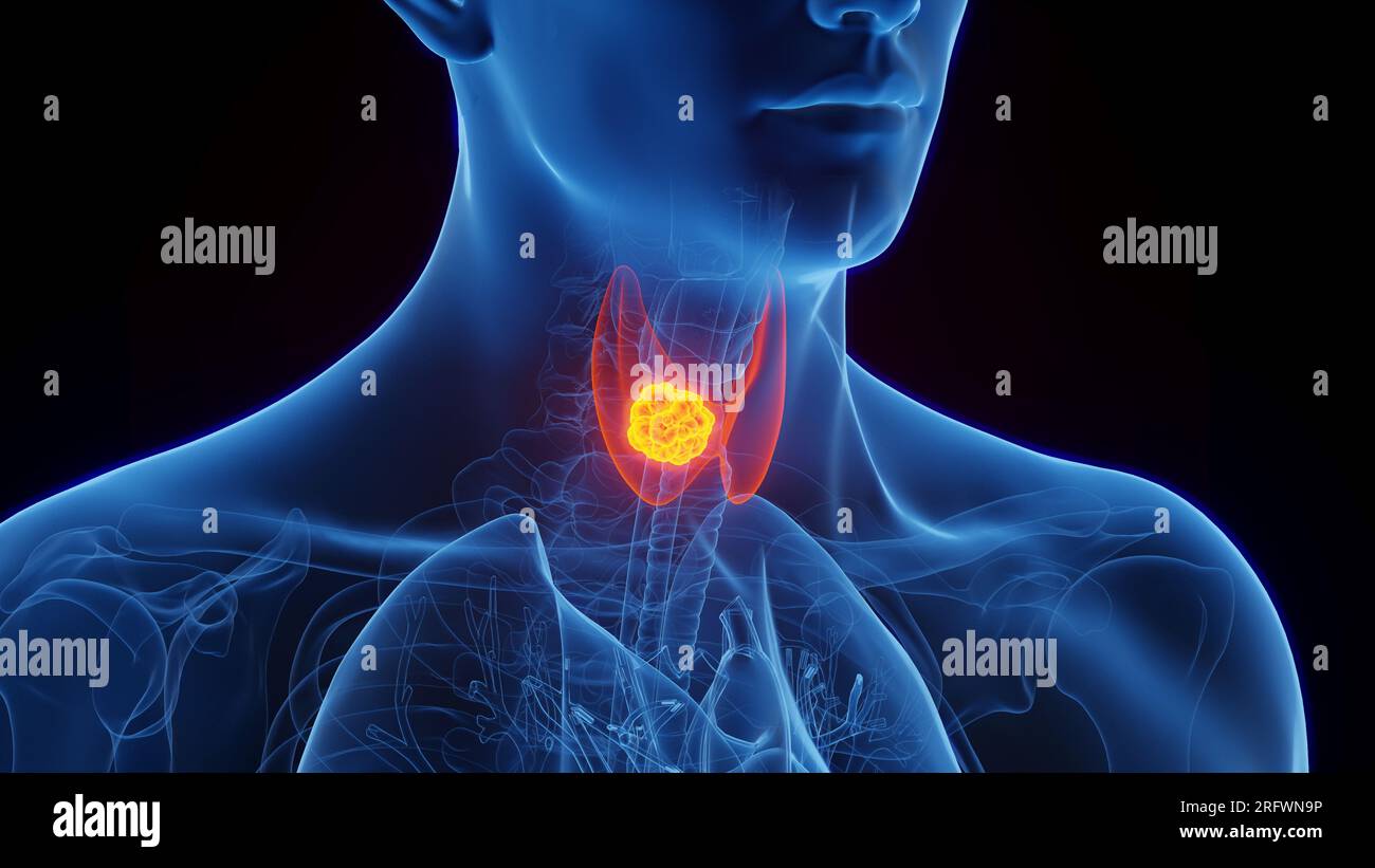 Cancro della tiroide, illustrazione Foto Stock