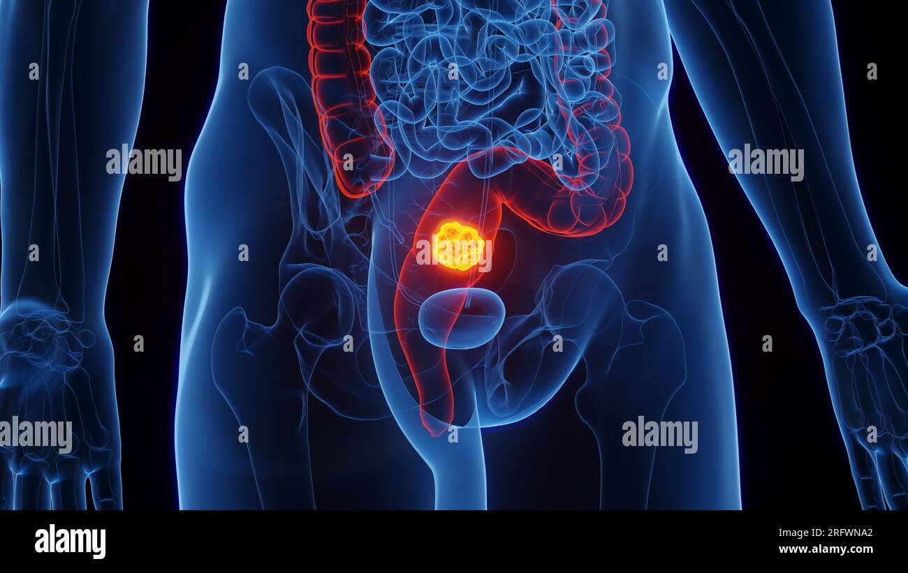 Cancro del retto, illustrazione Foto Stock