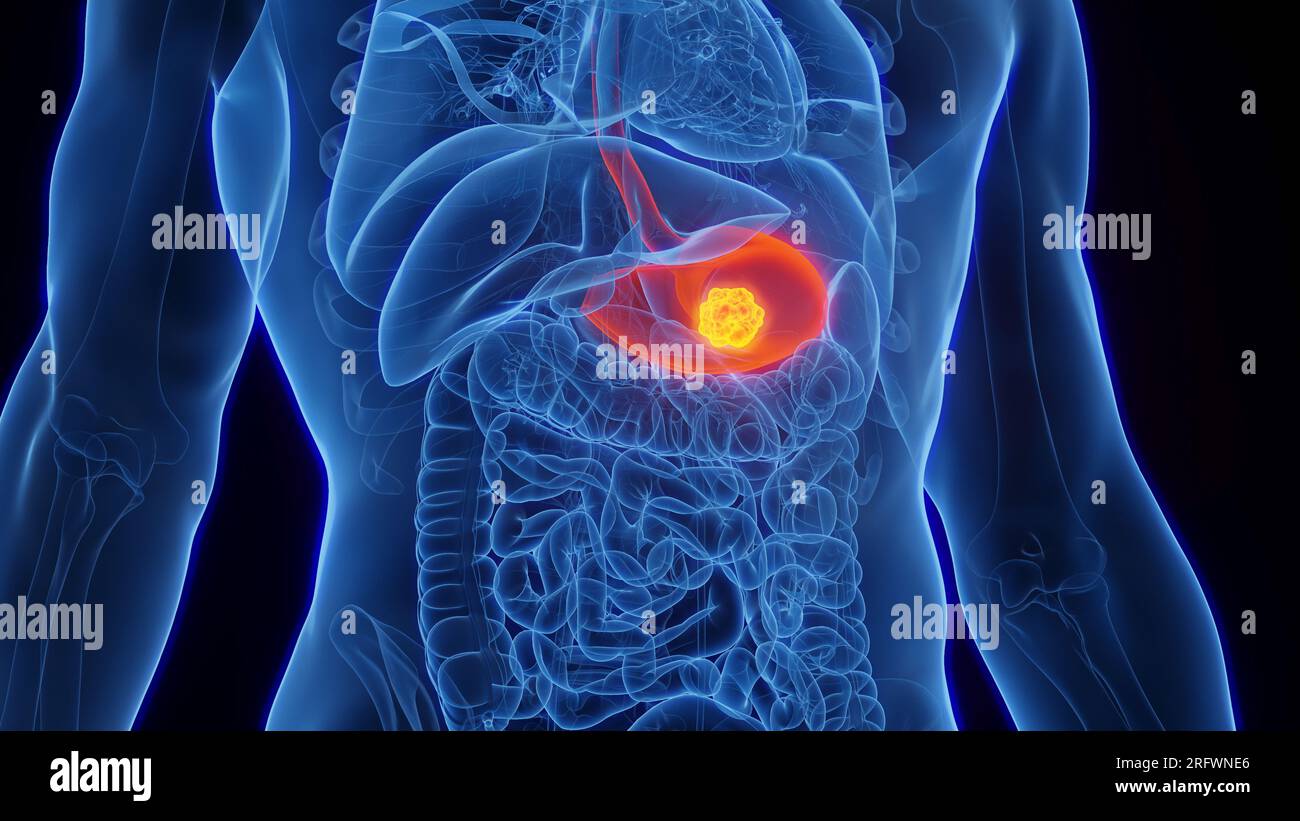 Il cancro dello stomaco, illustrazione Foto Stock