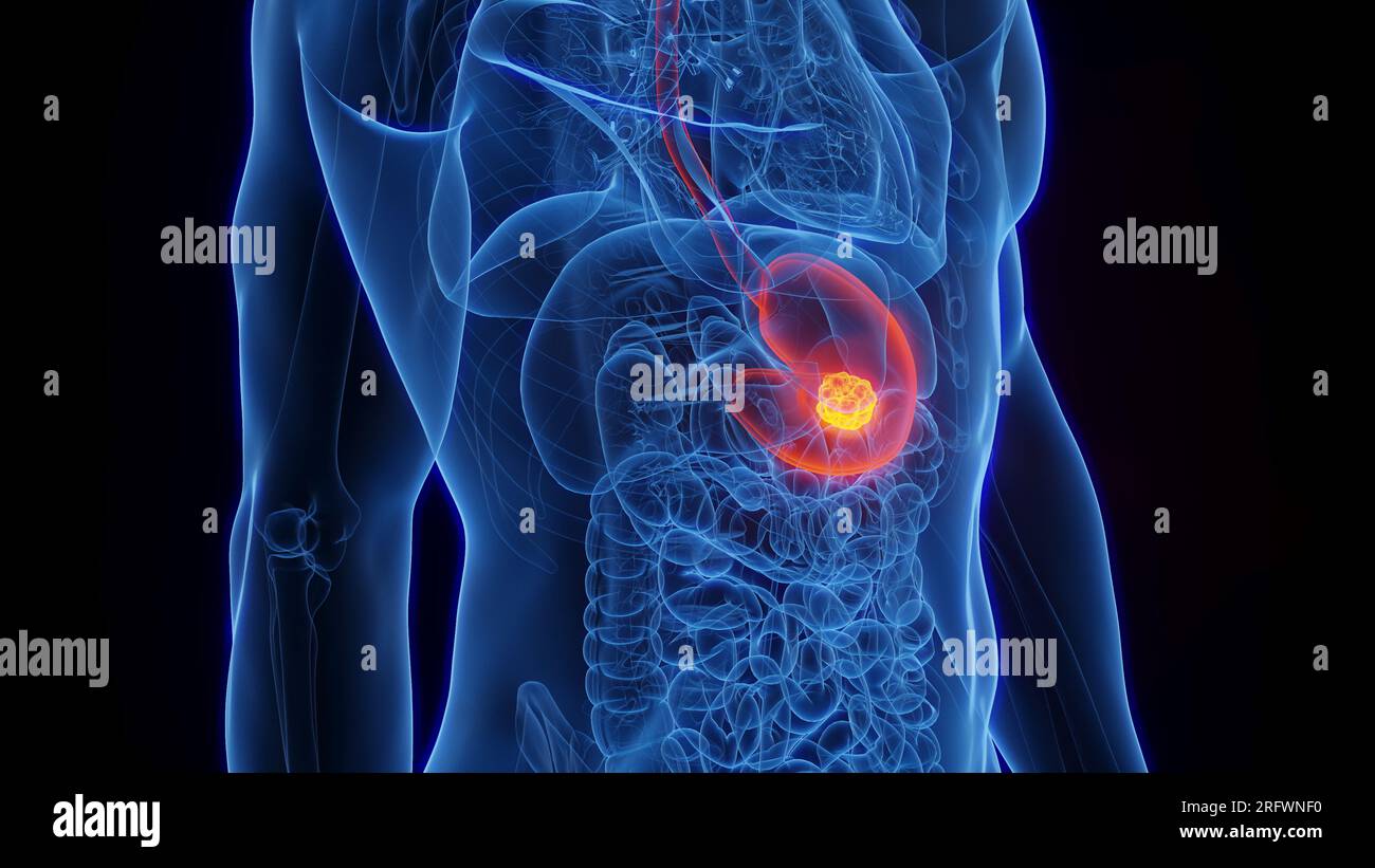 Il cancro dello stomaco, illustrazione Foto Stock