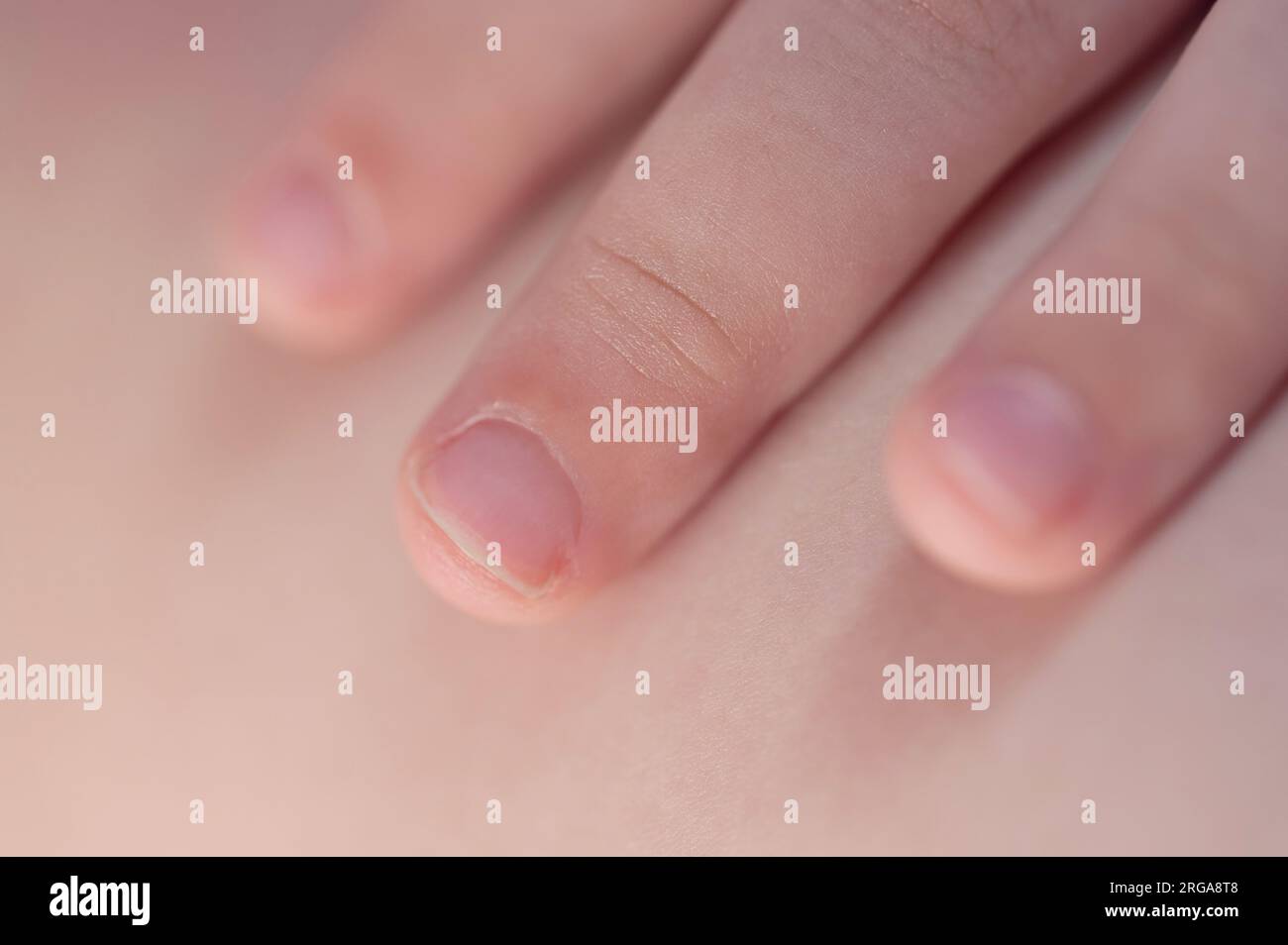 Baby suck finger problem macro close up view. Chiodo per dito danneggiato Foto Stock